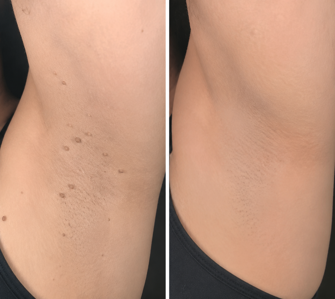 ⏰Ends Today: 60% OFF✨2-in-1 Microneedle & Hydrocolloid Patch | Removes Raised Moles, Acne, Flat Warts & Skin Tags -8RH7