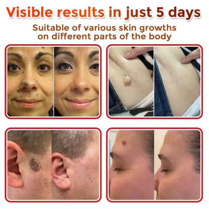 Microneedle Skin Tag Patch - 14-Day Clear Skin