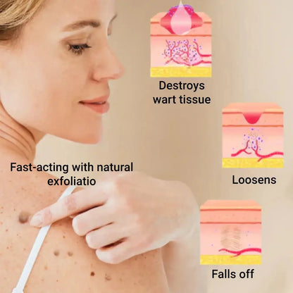 Microneedle Skin Tag Patch - 14-Day Clear Skin